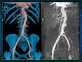 CTA of the Renal Arteries: What You Need to Know - Part 1