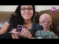 Adalia Rose: The Girl Who Ages Too Fast | BORN DIFFERENT