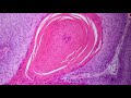 Seborrheic Keratosis: 5-Minute Pathology Pearls