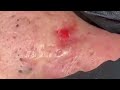 relaxing blackheads removal pimple popping videos blackheads removal large blackheads popping relax