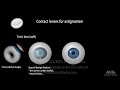 Astigmatism: Types, Causes, Symptoms and Treatment Options, Animation