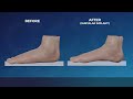 Subtalar implant procedure (arthroereisis) - flexible flatfoot surgery animation - Dworska hospital®