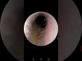 Otoscope right ear then left 09/07/2020