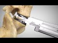 prodisc® L Surgical Technique Animation (2021) | Lumbar Total Disc Replacement | Disc Arthroplasty