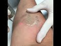 OUCH!! Laser Tattoo Removal Session #2!