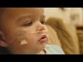 RSV Unmasked : A Professional Insight into Respiratory Syncytial Virus