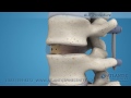 Anterior Lumbar Interbody Fusion (ALIF)