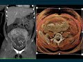 CT Evaluation of the Appendix: Appendicitis and Beyond - Part 1