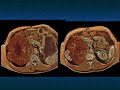 CT of the Large Adrenal Mass: Follow, Biopsy, Resect - Part 3