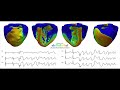 5.5 Euler's Method to Create a Model for Ventricular Fibrillation V2