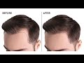 පිරිමින්ගේ තට්ටය ඇතිවීමට හේතු හා පිළියම් | Male Pattern Hair loss Treatments | Skin Specialist