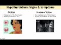 Signs of Low Thyroid Level (Hypothyroidism), & Why Symptoms Occur