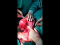 Cesarean Myomectomy by Dr Kishore Rajurkar