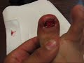 Toe Surgery!