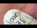 relaxing blackheads removal relax with Blackhead pimple popping satisfying removal amazing result