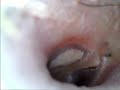 Otoscope right ear then left 15/07/2020