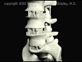 Anterior Lumbar Interbody Fusion (ALIF Part 3) Animation by Cal Shipley, M.D.