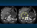 CT Evaluation of Adrenal Hemorrhage: A Challenging Diagnosis? - Part 2