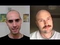 Balding Man More Attractive After Shaving Head Bald