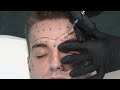 Male Botox Patterns & Injection Tutorial with 3D Anatomy!