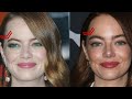 Emma Stone's Incredible Plastic Surgery Transformation