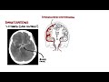 Subarachnoid Haemorrhage / pathophysiology, complications and management