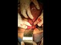 Internal iliac ligation by Dr Kishore Rajurkar HOD OBGY SGMH