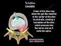 Sciatica - Everything You Need To Know - Dr. Nabil Ebraheim