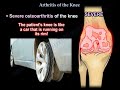 Knee arthritis symptoms and treatment - Everything You Need To Know - Dr. Nabil Ebraheim
