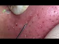 Blackheads removal pimple popping videos blackheads removal large acne popping very relaxing