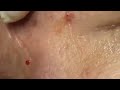 LARGE Blackheads Removal - Best Pimple Popping Videos