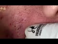 Blackheads removal pimple popping videos blackheads removal large blackheads popping very relaxing