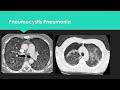 Pattern identification in CT Chest: A clinician's guide