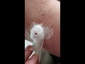 2 Minute Painful Plaster Removal (Blood and Gore)