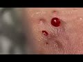 relaxing blackheads removal pimple popping videos blackheads removal large blackheads popping