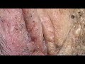 relaxing blackheads removal pimple popping videos blackheads removal large blackheads popping relax