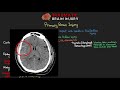 Overview of Traumatic Brain Injury (TBI)