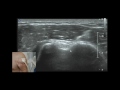 MSKUS Evaluation of the Shoulder