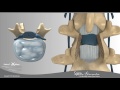 Lumbar Laminectomy and Fusion Presented by Swift Institute, Reno Spine Surgeons and Spine Center