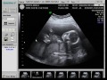 Baby Boy Ultrasound