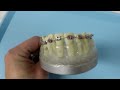 How braces move teeth (time-lapse) - Braces Explained!