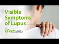 The Expert Series S6E2: Visible Symptoms of Lupus