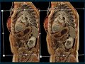 Gastric GIST Tumors: Pearls and Pitfalls - Part 1