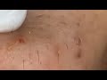 Satifying blackhead whithead popping pimple relaxing satisfying removal spa extremely satisfying