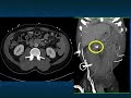 CT Evaluation of GI Bleeding - Part 2