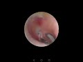 ear otoscope right ear then left 03/07/2020