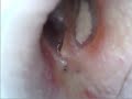 Otoscope 17/07/2020 right ear then left ear